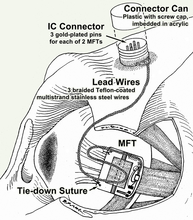 MFT-M Implant